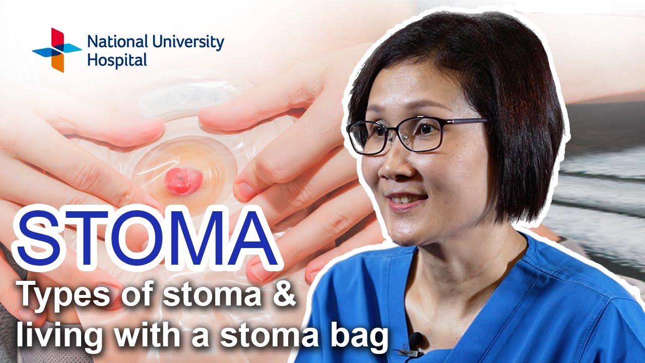 Stoma – Types of Stoma and Living with a Stoma Bag