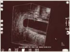 Endoanal ultrasound2.jpg