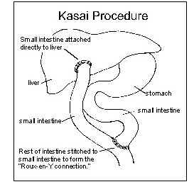 Kasai Procedure.jpg