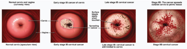 Cervical Cancer_cervial-02.jpg