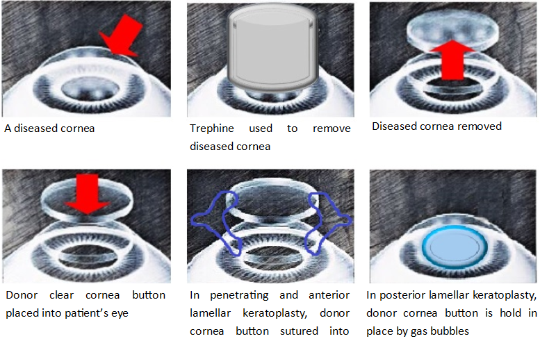 How is a cornea transplant performed.png