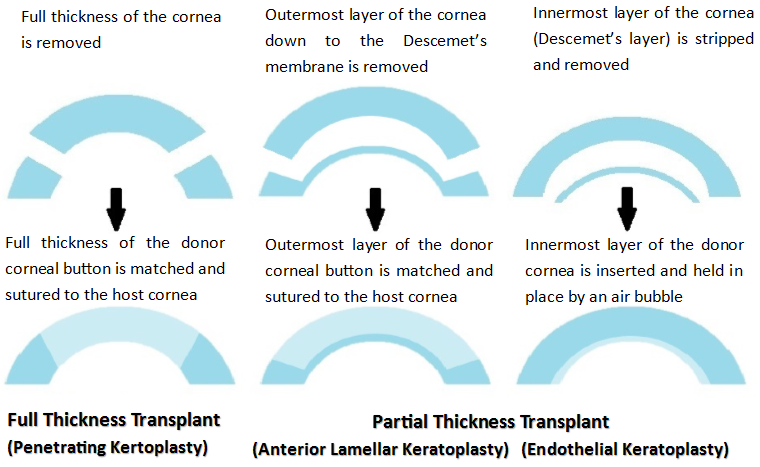 What Is a Corneal Transplant.png