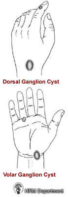 Ganglion Cysts_picture 1_caption.jpg