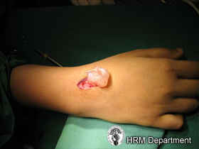 Ganglion Cysts_picture 2_caption_Surgical excision of a dorsal wrist ganglion.jpg