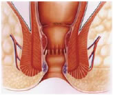 Stapled hemorrhoidectomy Fig 2.jpg