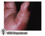 Hand Infections_Infective tenosynovitis_picture.jpg