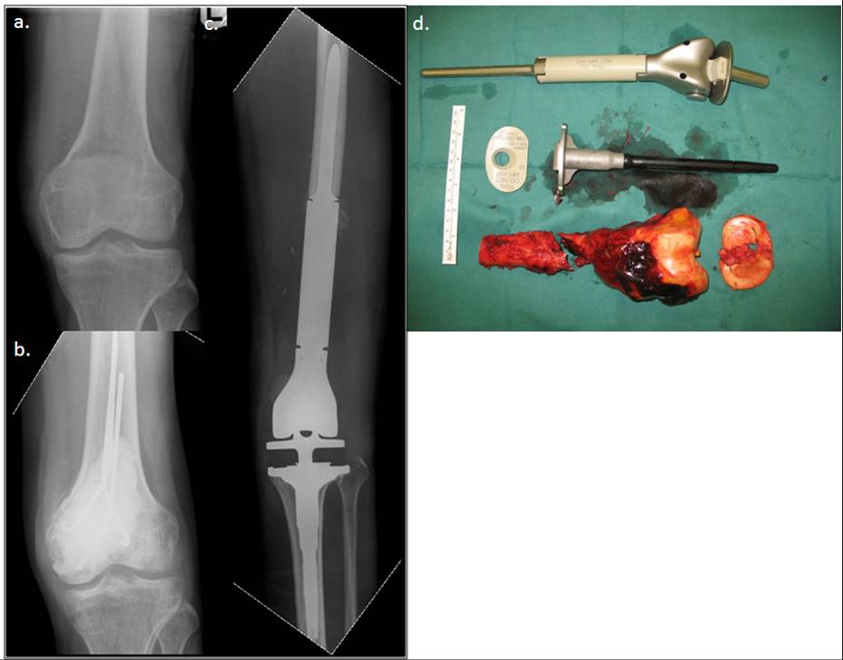Muscuskeletal Oncology_Primary cancers of the bones_picture (Fig 1).jpg