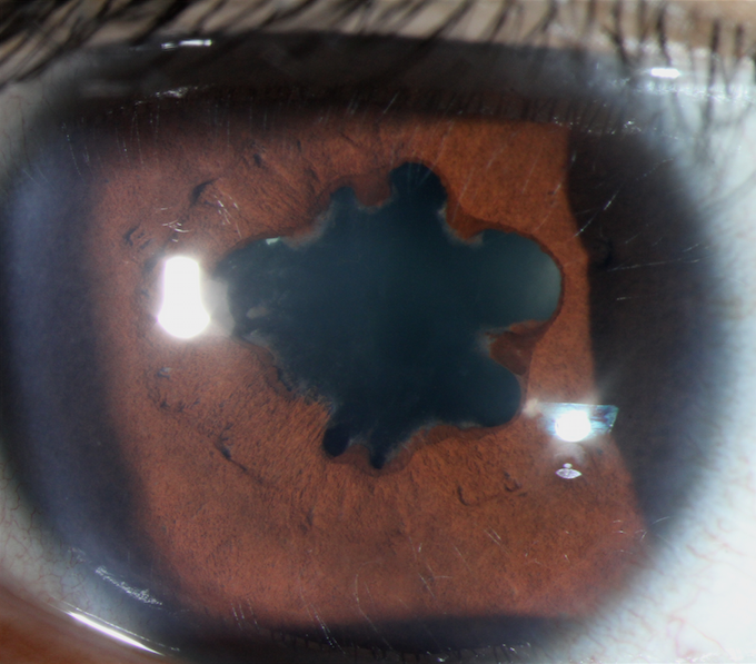 Irregular pupil from posterior synechiae.png