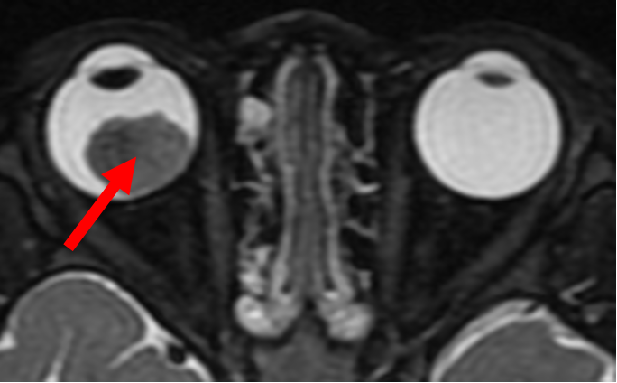 MRI scan of retinoblastoma.png