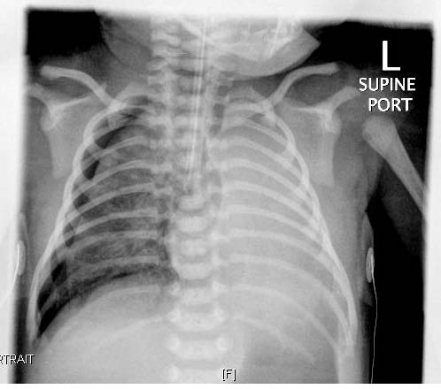Respiratory Distress Syndrome – RDS_Air Leak.jpg