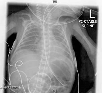 Respiratory Distress Syndrome – RDS_Post-surfactant administration.jpg