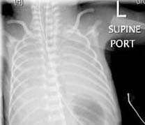 Respiratory Distress Syndrome – RDS_Pre-surfactant administration.jpg