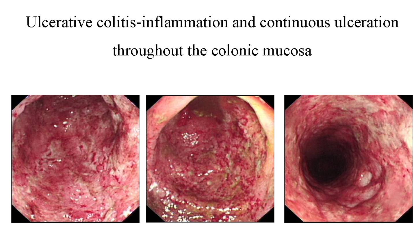 Ulcerative Colitis_UC.jpg