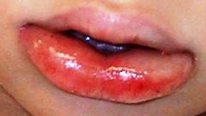 Angioedema Lips pic 2.jpg