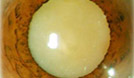 Cataract