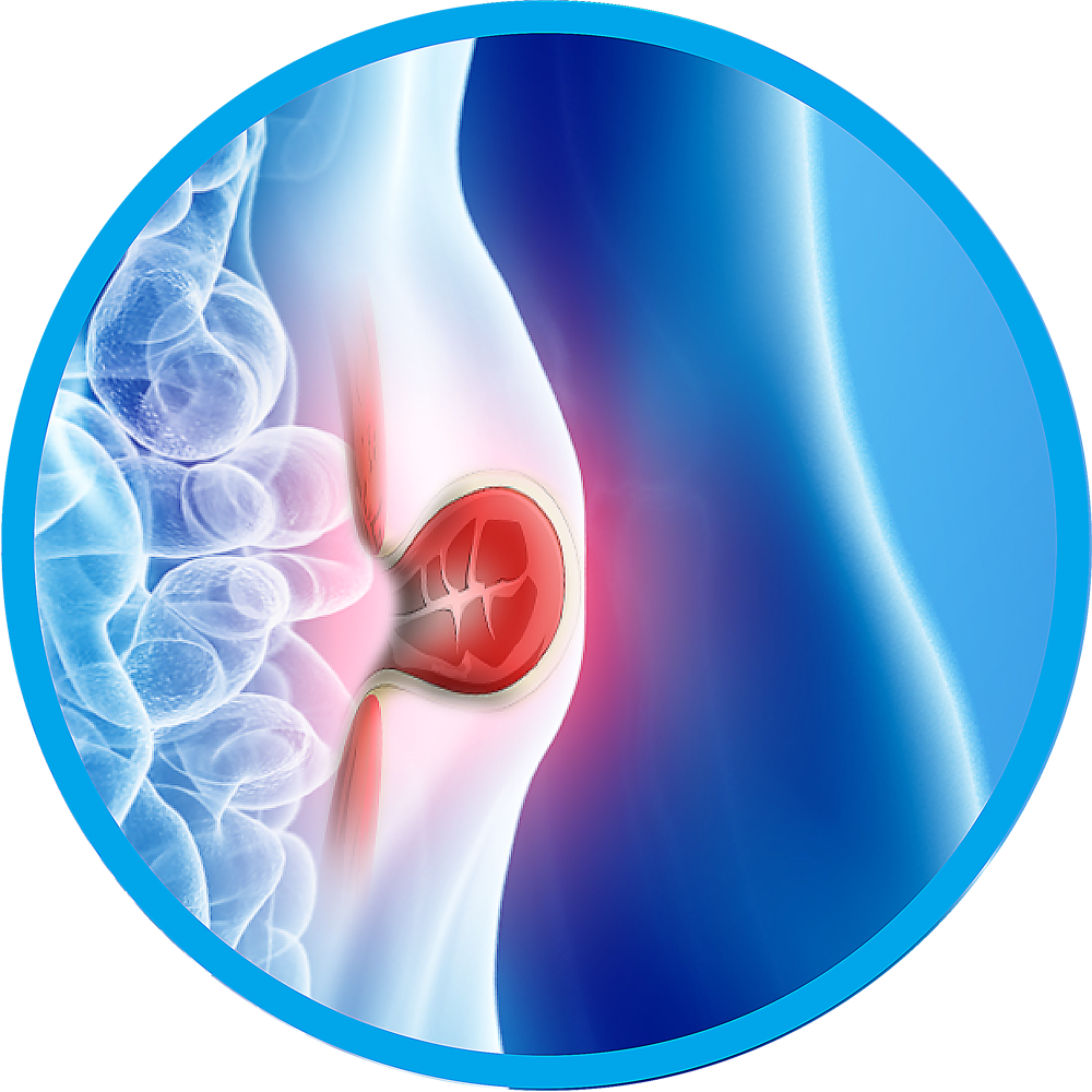 Hernia Surgery