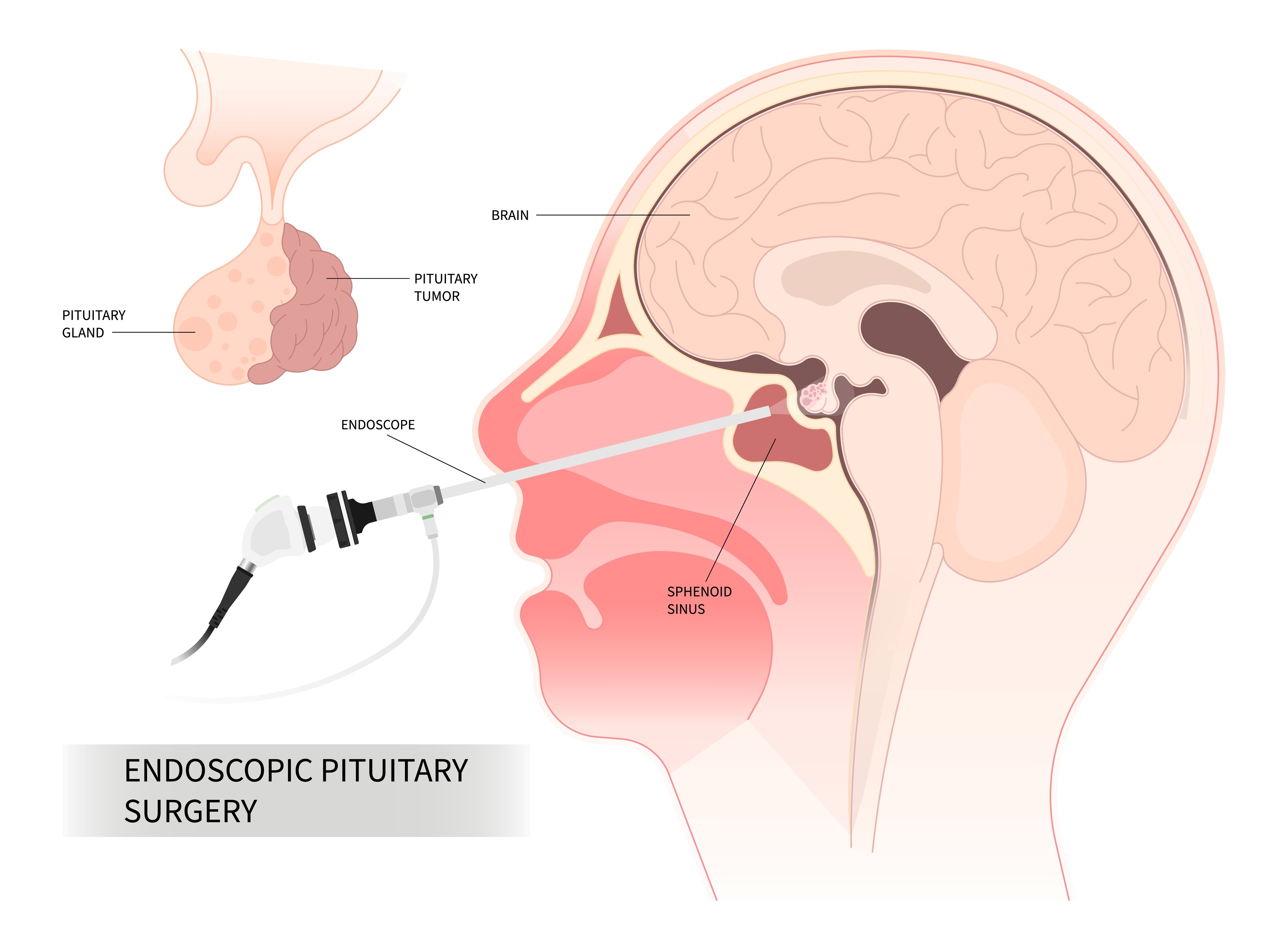 Endoscopic Pituitary Surgery