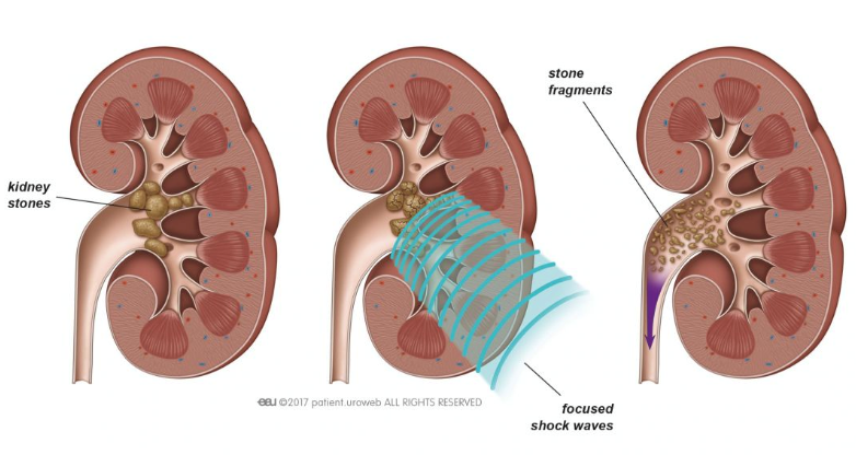 Services for Kidney Stones