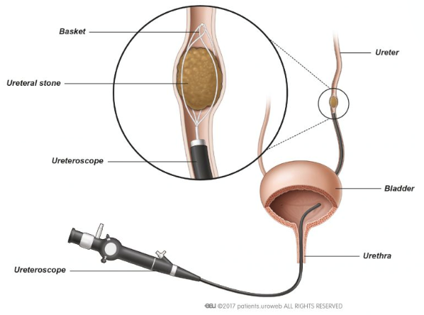 Services for Kidney Stones