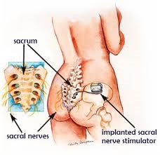 Services for Sacral Neuromodulation