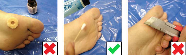 Dealing with corns and calluses