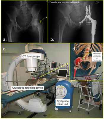 Musculoskeletal Oncology