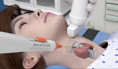 Radiofrequency ablation (RFA) procedure