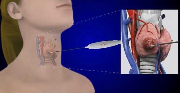 RFA procedure details