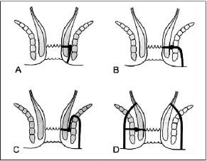 Anal fistula Classifications