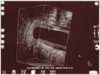 Endoanal Ultrasound Fig. 2