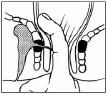 Digital examination of Fistula