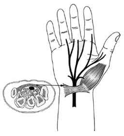 Carpal tunnel syndrome