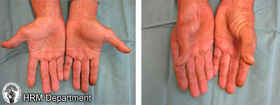 Carpal tunnel syndrome signs and symptoms