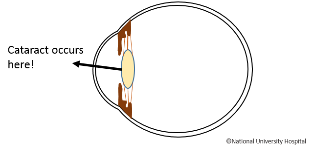 Cataract Occurs Here