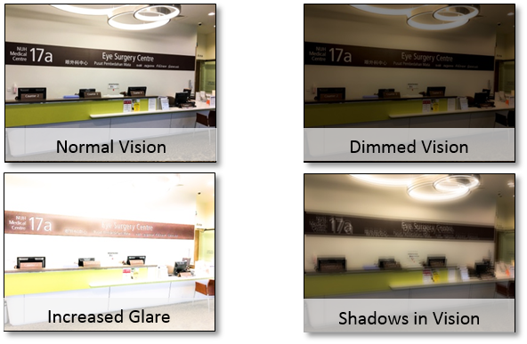 Cataract Vision