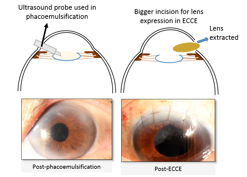 Cataract Surgery