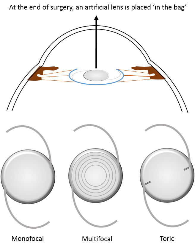 What are intraocular lens