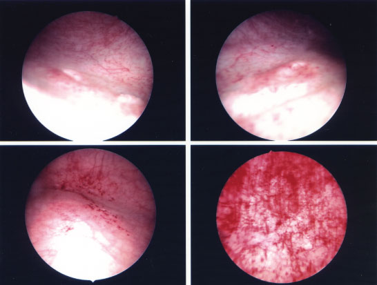 Cystoscopy