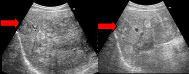 Ultrasound of the liver