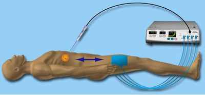 Radiofrequency Ablation (RFA)