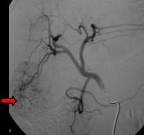 Transarterial Chemoembolisation (TACE)