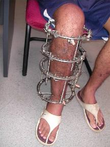 Correction of deformity