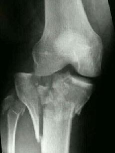 Tibia (lower leg)