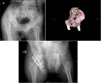 Fracture right acetabulum