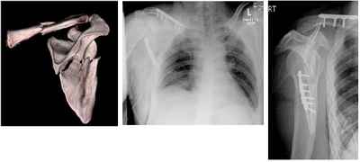 Upper Arm (humerus shaft)