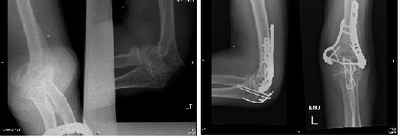 Proximal Humerus