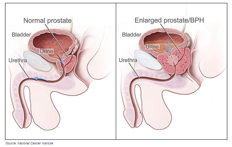 Normal to BPH comparison