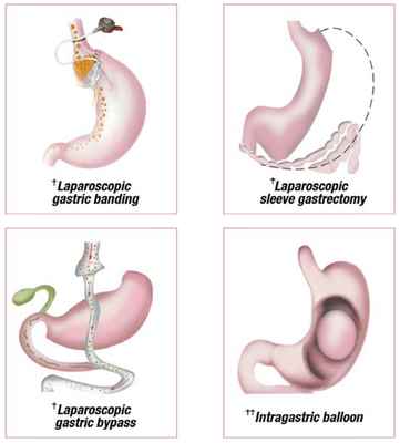 Surgical Options