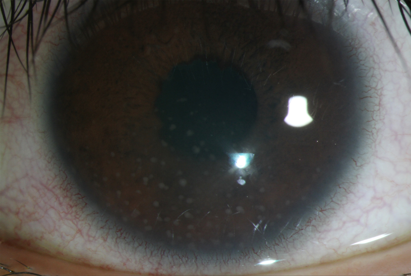 Keratic precipitates