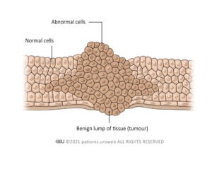 Benign tumours